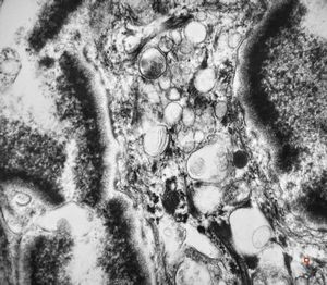 M,66y. | follicular cyst with hyaline Rushton bodies